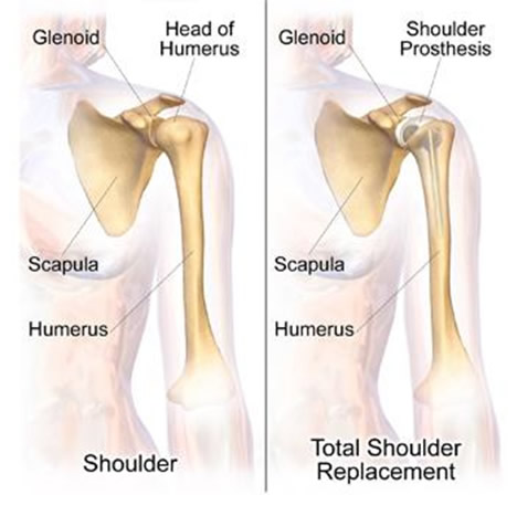 Shoulder Replacement